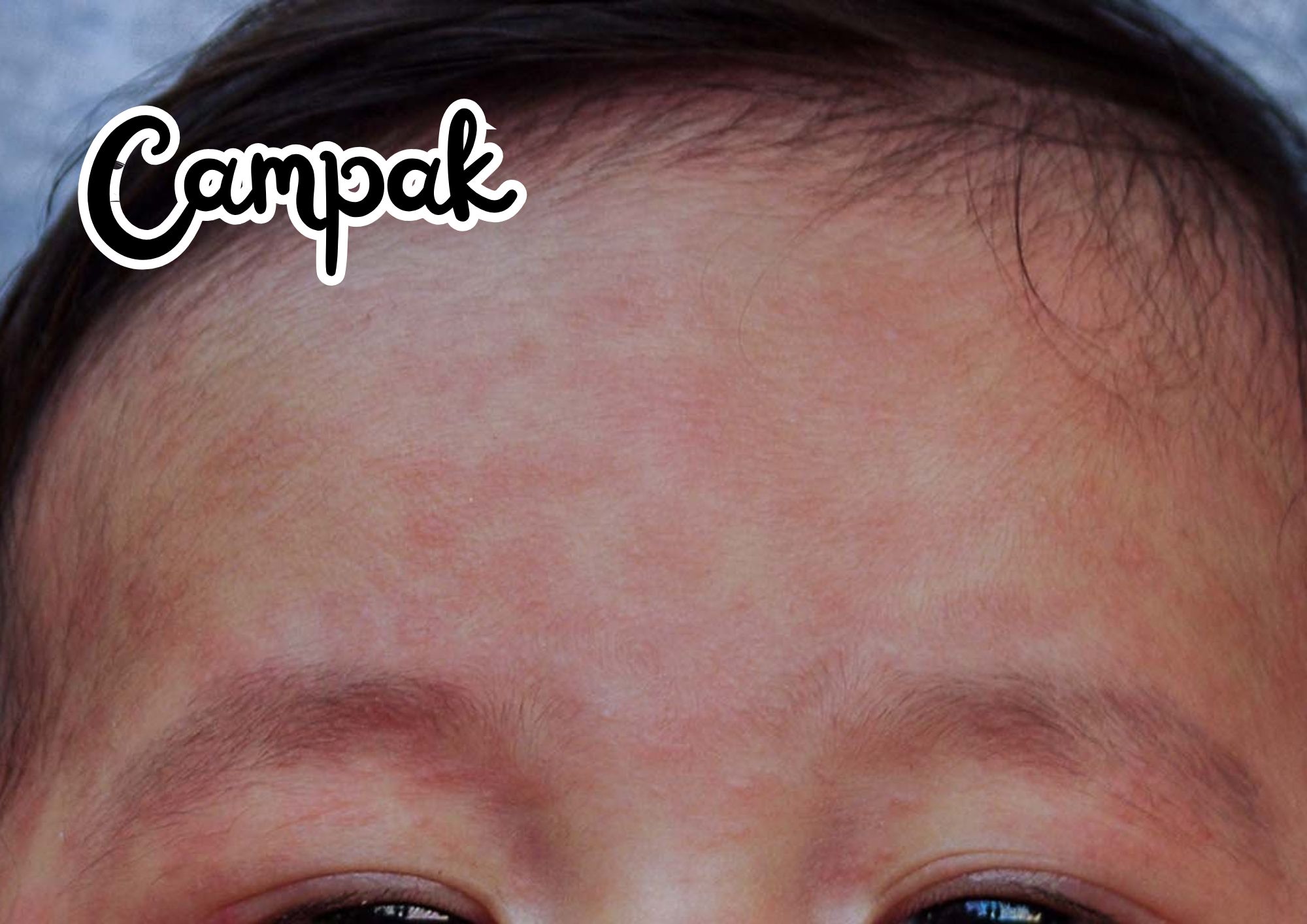 Campak