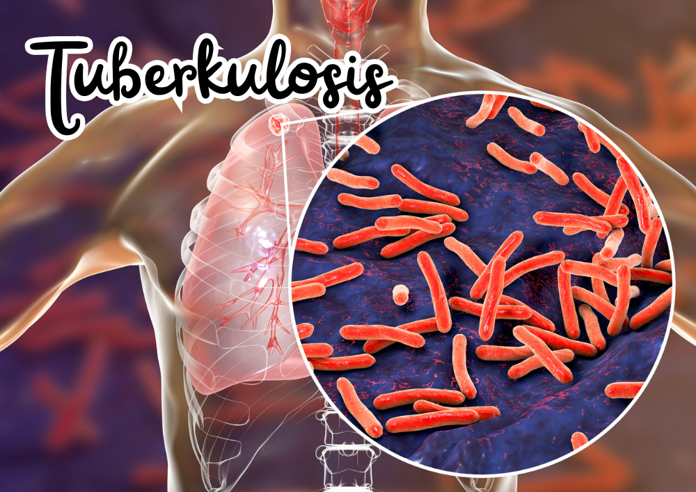 Tuberculosis (TBC)